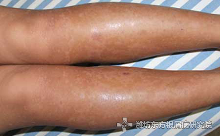 预防银屑病