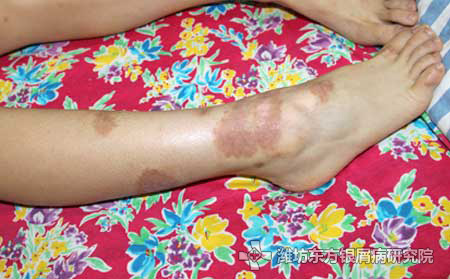 寻常型银屑病的防治