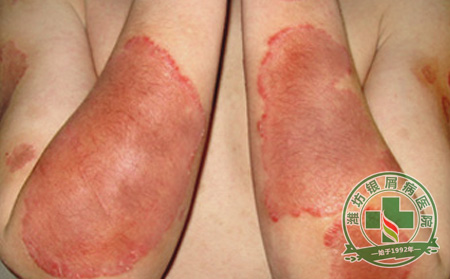 青少年银屑病治疗误区有哪些?