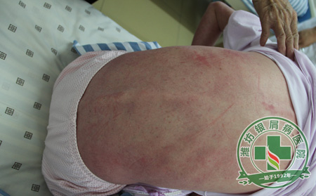 健康问答: 父亲患有银屑病会遗传给我吗?