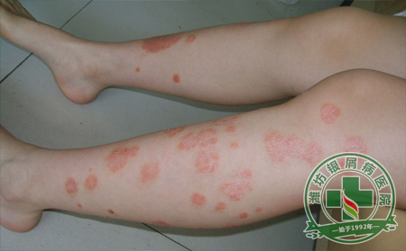 银屑病护理