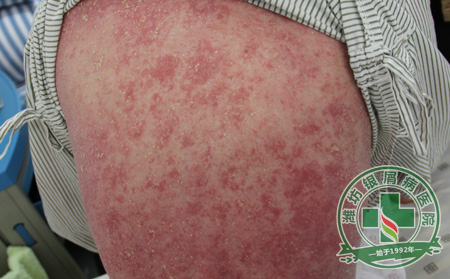 银屑病患者在夏季怎样预防复发？