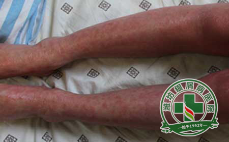 银屑病患者在夏季怎样护理?