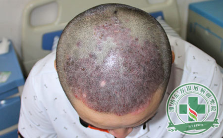 牛皮癣患者在治疗中应把握这些要点