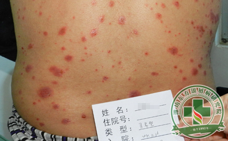 牛皮癣患者需要了解的牛皮癣症状常识