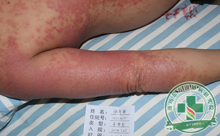潍坊治疗牛皮癣患者选择什么样的医院?