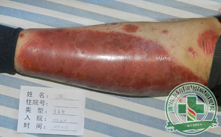 潍坊红皮型牛皮癣病因和护理方法