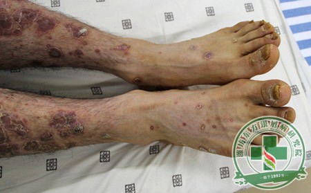 脚部僵冷 寻常型银屑病患者怎样顺利预防