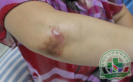 哪些认识误区让银屑病治疗困难