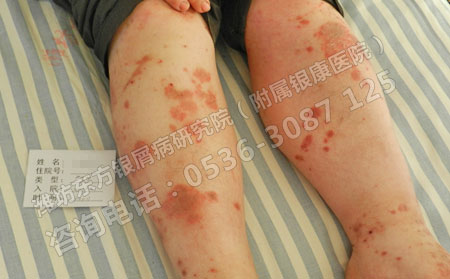 银屑病反正都要复发还有治疗的必要吗