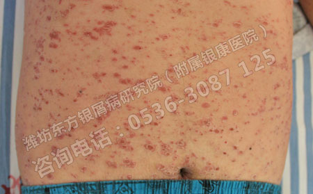 比较严重的牛皮癣类型怎么治疗