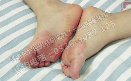 哪些就医误区让银屑病好的慢