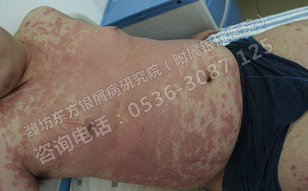 银屑病恢复热线是多少