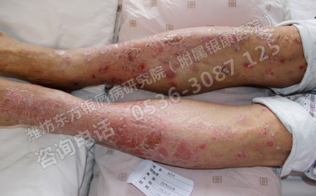 专业治疗银屑病老牌子医院