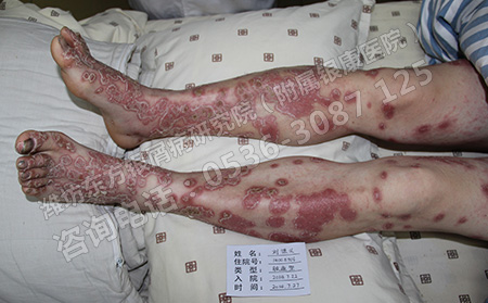 关节型银屑病关节部位疼痛怎么办