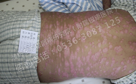 潍坊银屑病医院：癣是牛皮癣吗
