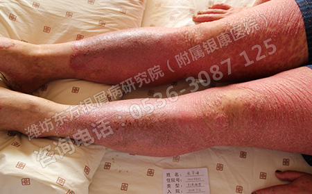导致银屑病加重的原因是什么?