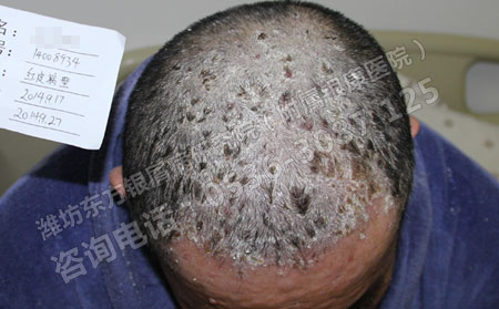 潍坊银屑病患者头部症状怎样治疗