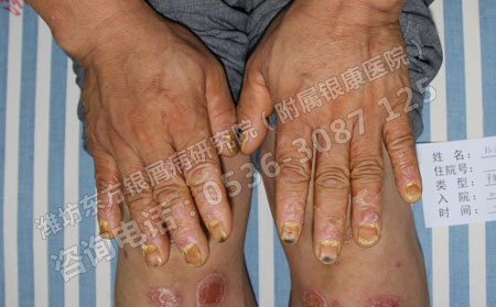 潍坊银屑病患者怎样预防病情复发