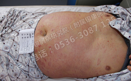 潍坊什么医院看牛皮癣可以