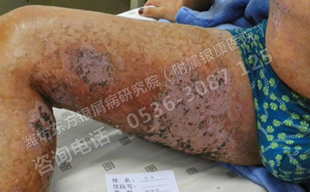 潍坊哪家医院看银屑病效果非常好