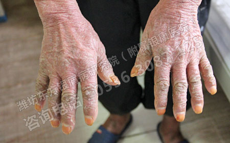 潍坊治银屑病哪里可以