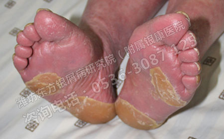 潍坊哪家医院看银屑病比较好