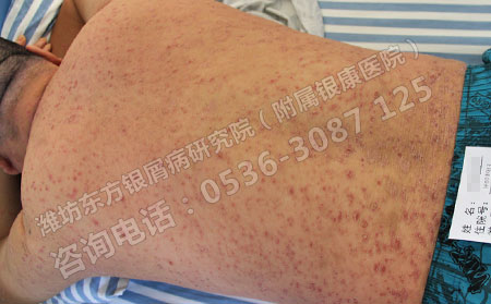 潍坊治疗不同类型牛皮癣的方法