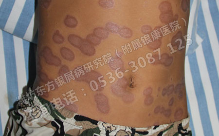 潍坊哪所医院治疗银屑病