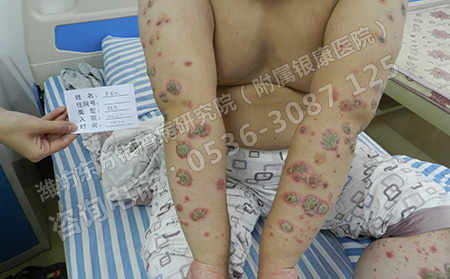 潍坊的医院治银屑病怎么样
