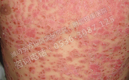潍坊哪里治银屑病效果好