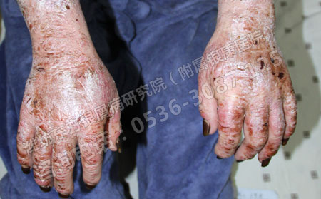 关节型银屑病是怎么引起来的