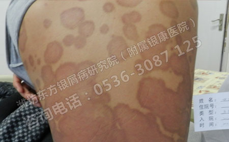 潍坊银屑病医院浅谈银屑病的治疗规范