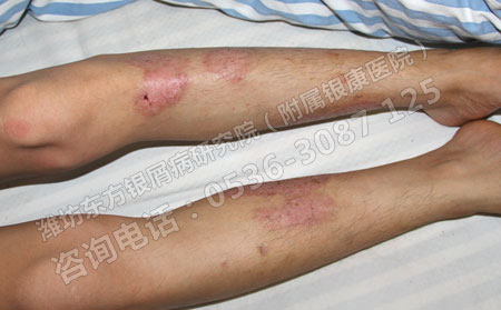 为什么银屑病患者要选择专业的医院治疗