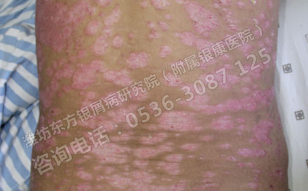 什么样的皮肤病变是银屑病?