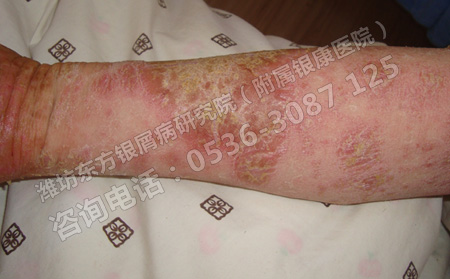潍坊中医哪家医院治牛皮屑可以
