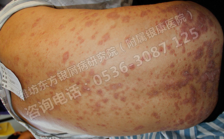 哪些误区会影响牛皮癣病情恢复不利于可以转