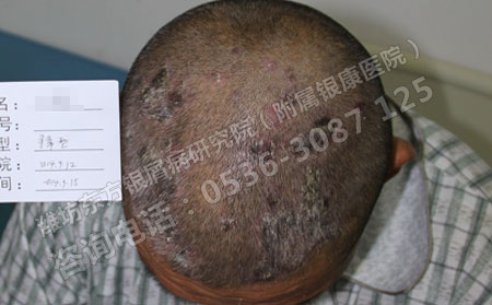 头部长了银屑病怎么治？
