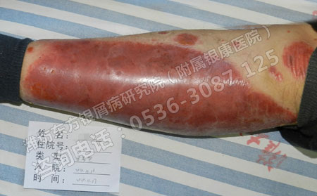 春季银屑病复发到哪家医院治疗好