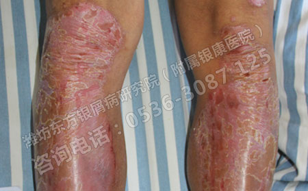 诱发脓疱型银屑病怎么办？
