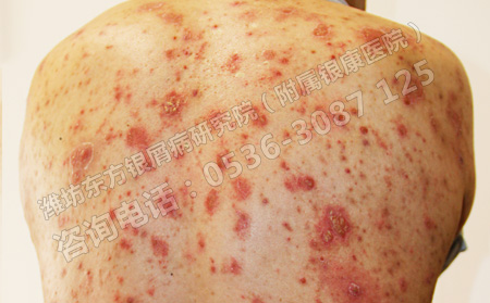 牛皮癣一而再再而三复发究竟是怎么回事