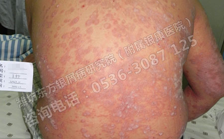 治疗银屑病要注意哪些原则呢