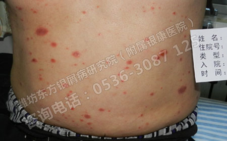 寻常型牛皮癣危害大不大 该不该治疗呢
