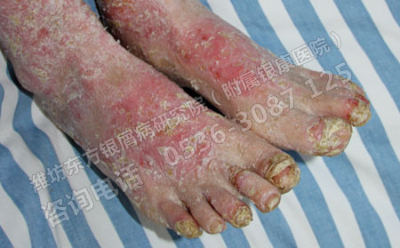 掌趾脓包病传染吗