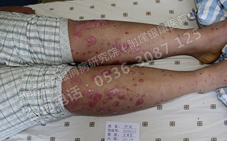 潍坊银屑病医院坚持个性化治疗