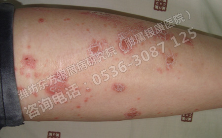潍坊初期银屑病患者该如何进行治疗