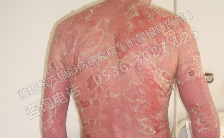 潍坊有没有什么好的方法治疗牛皮癣