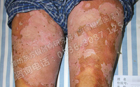 治疗银屑病的非常好方法是什么