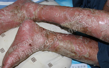 中医治疗银屑病有什么副作用吗