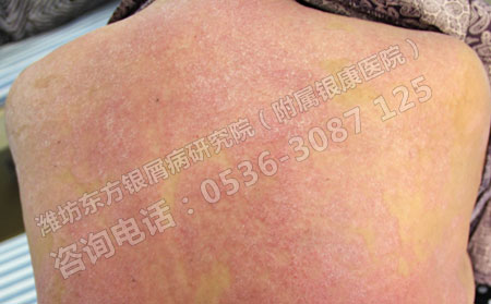皮肤病银屑治疗